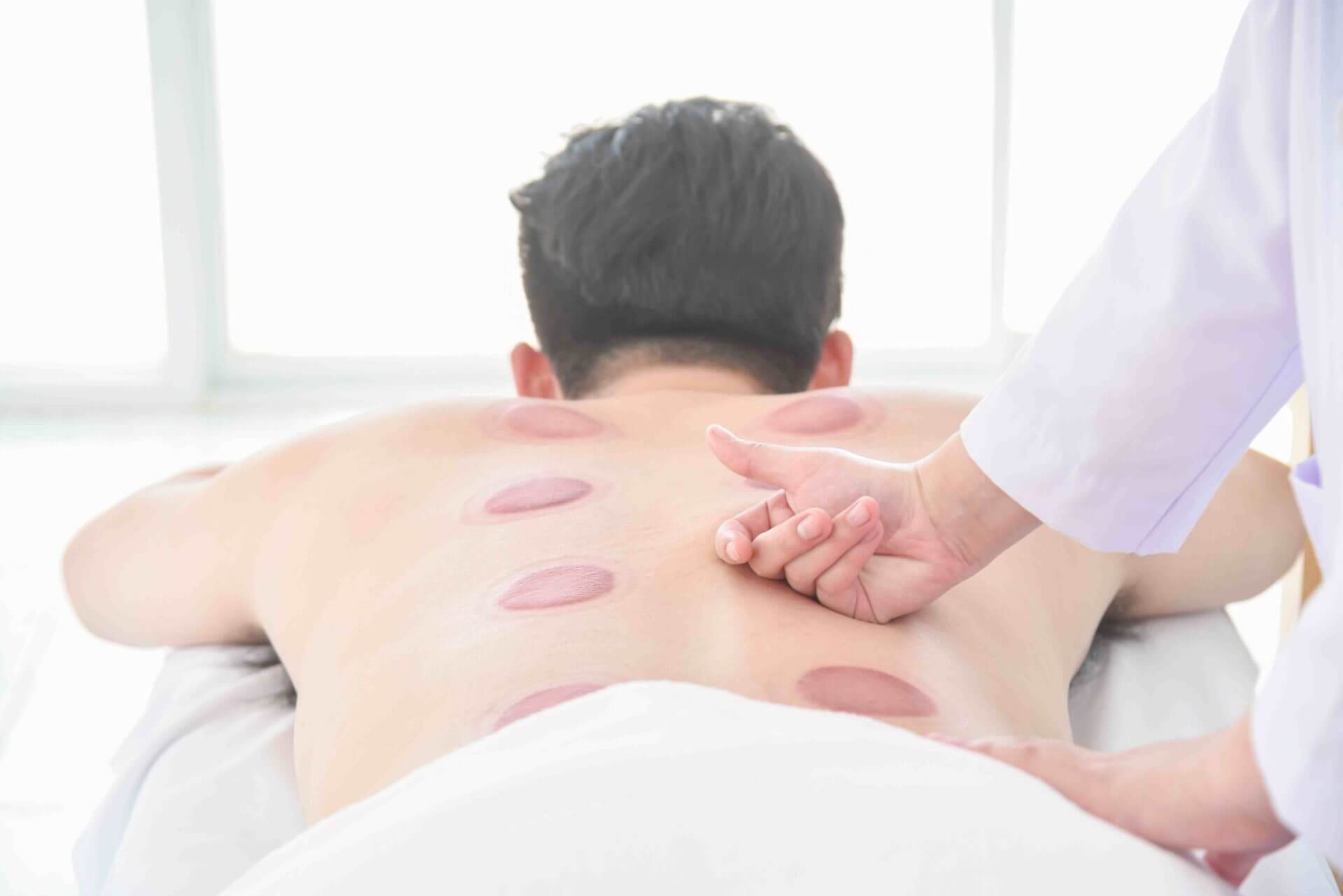 Active Cupping Treatment img 2