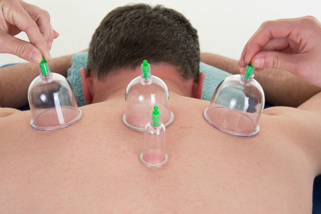 Cupping Therapy And Benefits Of Cupping Therapy Regen Physio Program