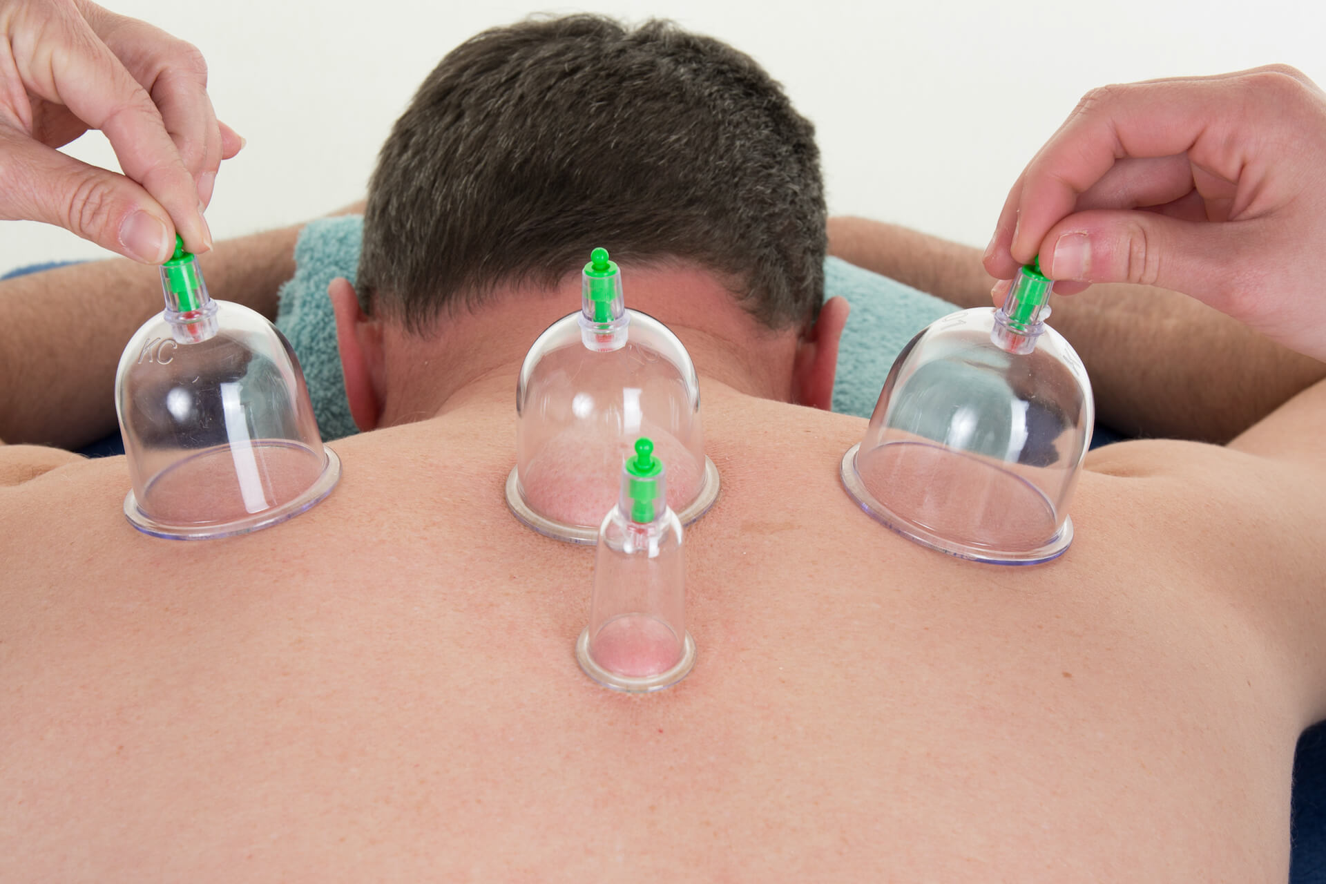 The Top 6 Benefits of Cupping Physical Therapy for Active or Athletic Men and Women Over 40
